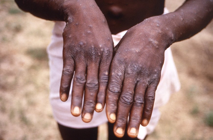 Kenya Confirms 3rd Case Of Monkey Pox